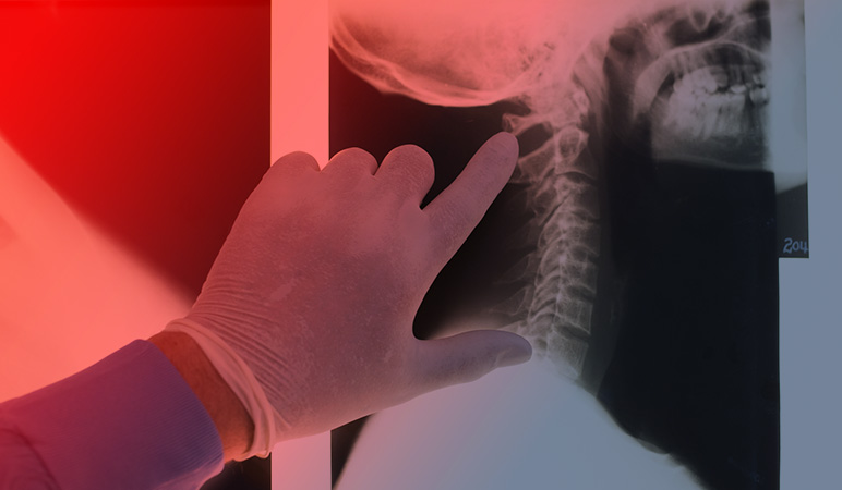 Abogado de lesiones de la medula espinal en dallas