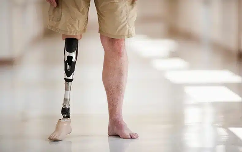 amputation claim