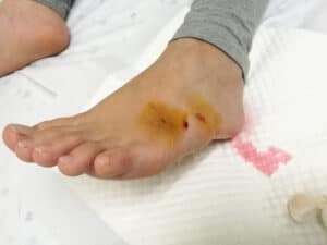 A child’s foot injury being treated after a Dallas dog attack incident.