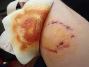 A dog bite injury requiring medical care, relevant to proving liability under Texas's one-bite rule.