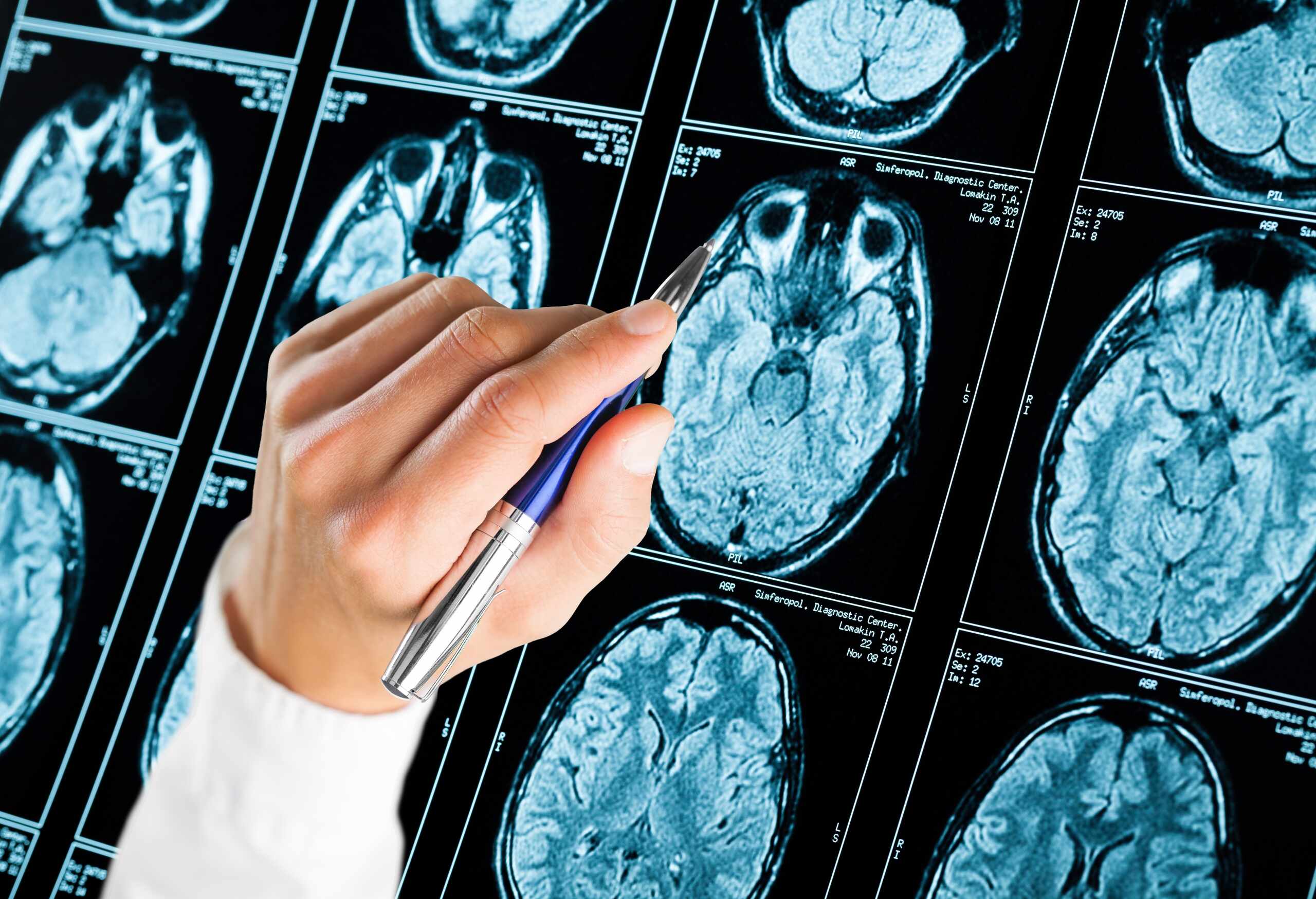 Why concussions are often undervalued dallas accident